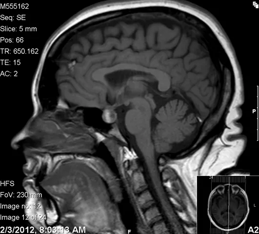 MRI brain pituitary macroadenoma