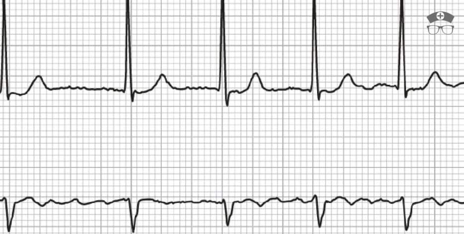 Cardizem Drip Protocol For A-fib 